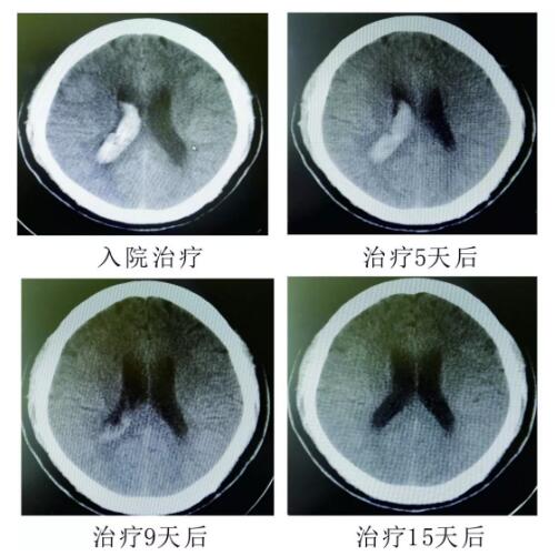 腦出血你不得不引起重視的疾?。。。?></a></div>
               
 					<div   id=