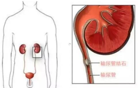 輸尿管結(jié)石，到底能不能保守治療？