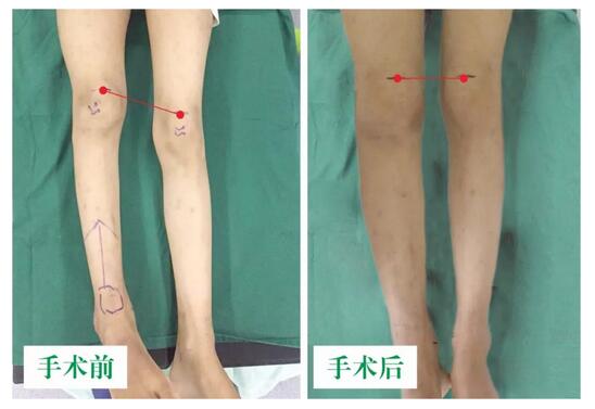 女孩墜梯右腿縮短5cm，幸得醫(yī)生及時診治恢復(fù)正常腿型