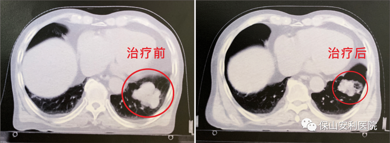 不做手術(shù)，早期肺癌也能根治！