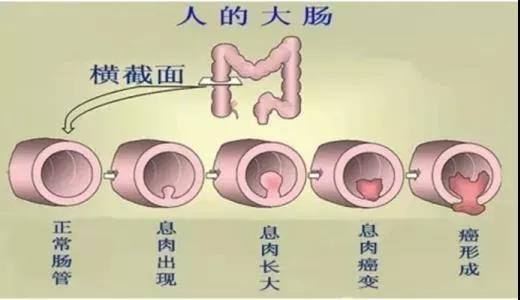 體檢發(fā)現(xiàn)腸息肉會癌變嗎？